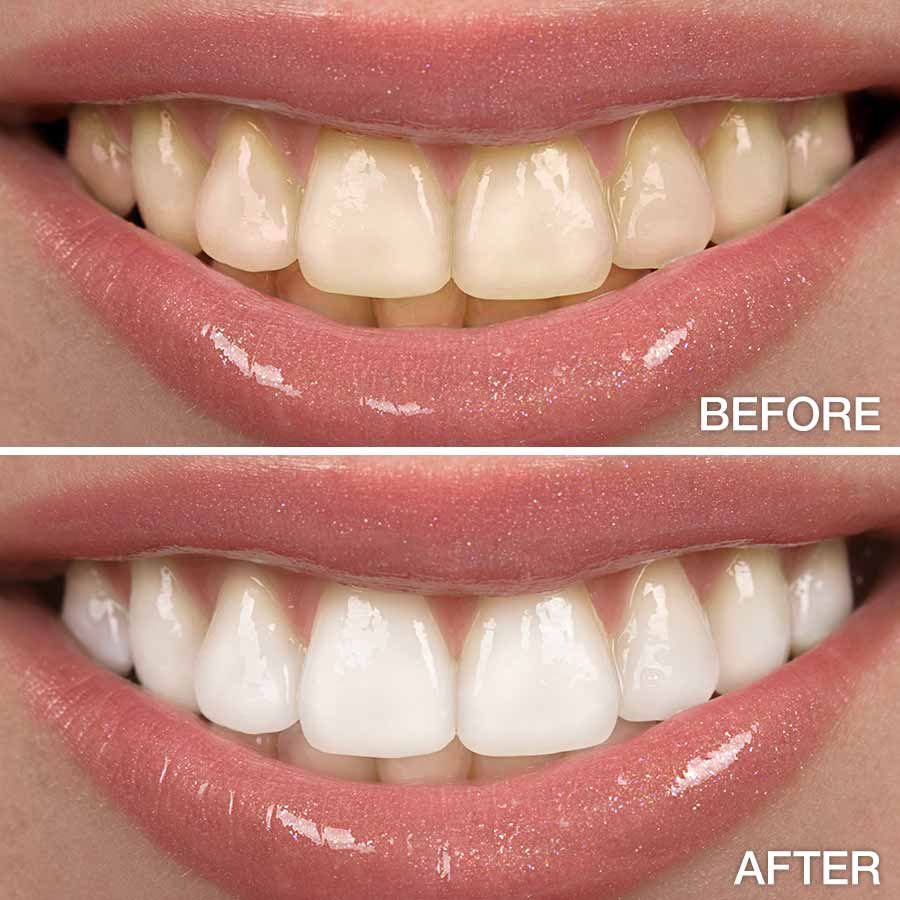 Dental Bleaching