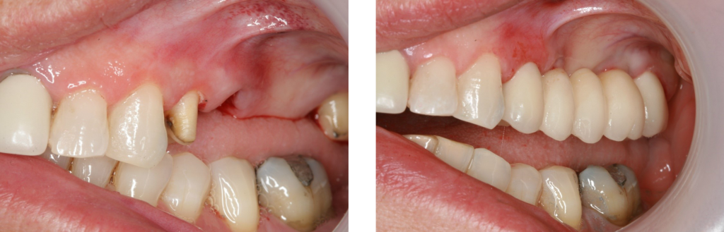 Προσθετική