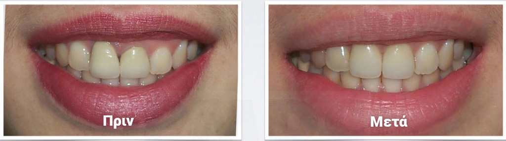 Ολοκεραμικές-Στεφάνες